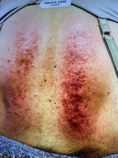 4009 Individualized local treatment during management of the patients musculoskeletal presentation